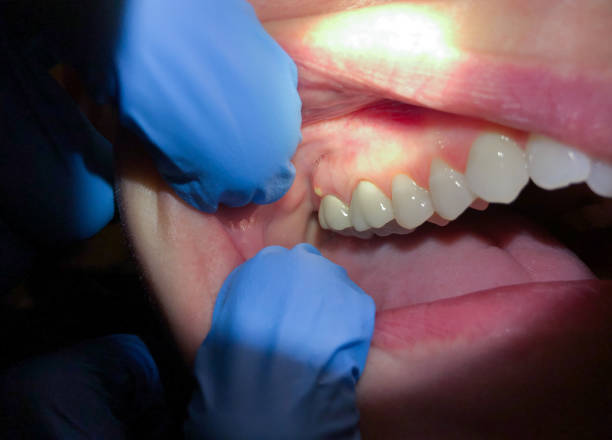 Best Emergency Root Canal Treatment in Meadowlakes, TX