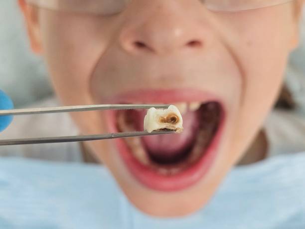 Best Broken or Cracked Tooth Emergency Dentist in Meadowlakes, TX