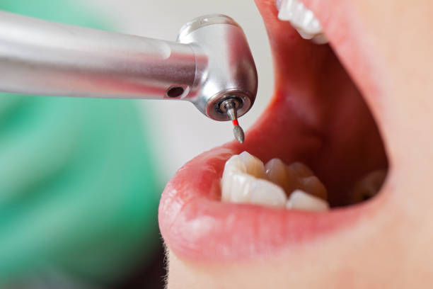 Best Emergency Root Canal Treatment in Meadowlakes, TX